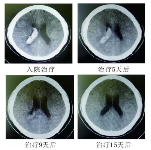 腦出血你不得不引起重視的疾?。。。?></a></div>
               
 					<div   id=