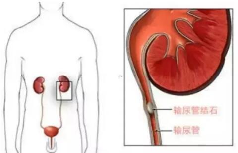 輸尿管結(jié)石，到底能不能保守治療？