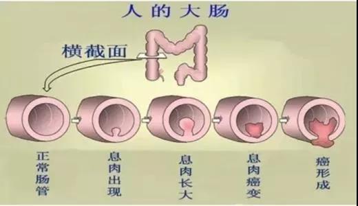 體檢發(fā)現(xiàn)腸息肉會癌變嗎？